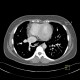 Scimitar syndrom, anomalous return of pulmonary vein: CT - Computed tomography